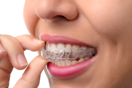 Get Invisalign in Rocklin, CA | Schedule a Free Consultation