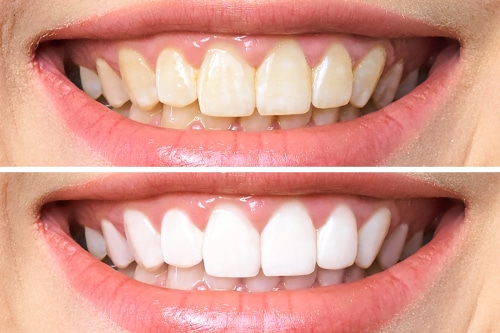 Teeth Whitening in Rocklin, CA | Book a Free Consultation