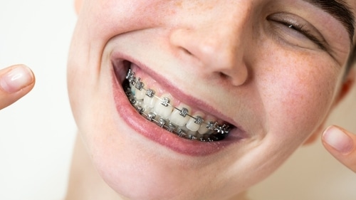 Braces in Rocklin, CA | Schedule A Free Consultation