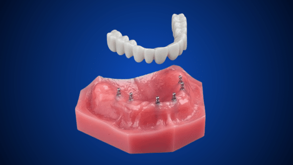 Implant Dentures in Rocklin, CA | Book a Consultation